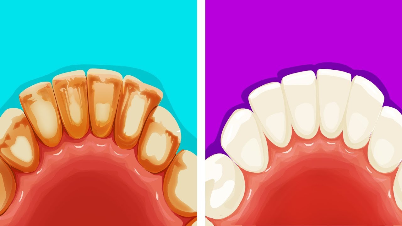 6 Productive Ways to Remove Dental Plaque Naturally