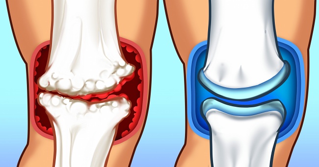 15 Foods You Need to Consume to Get Rid of Joint Pain