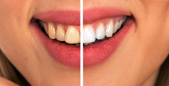 8 Tips to Naturally Reverse Cavities and Heal Tooth Decay