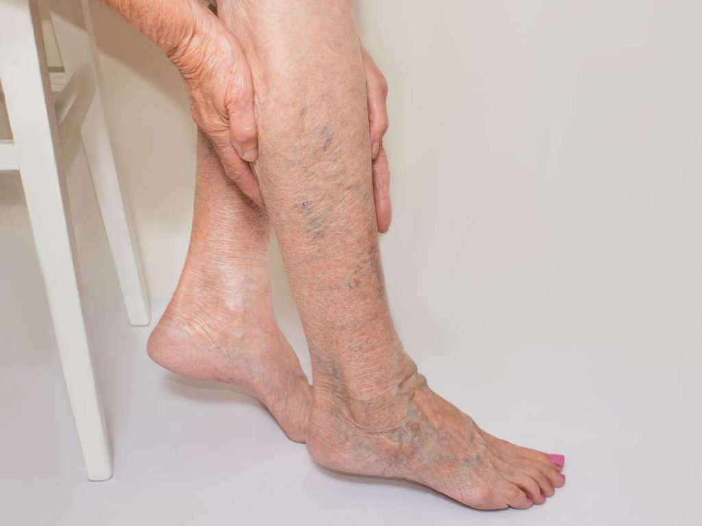 Varicose veins have a dark blue or purple appearance and may bulge out from underneath the skin.