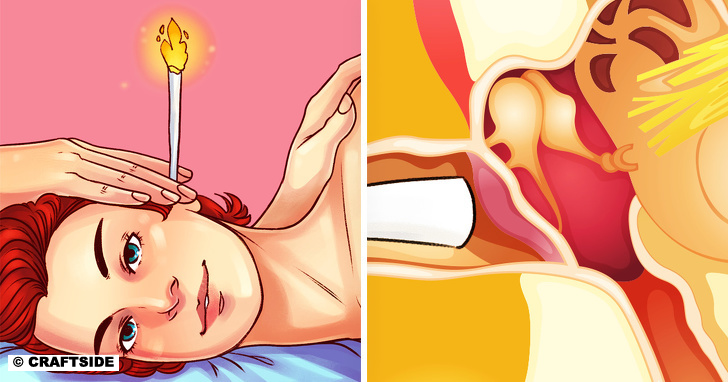 Candling earwax