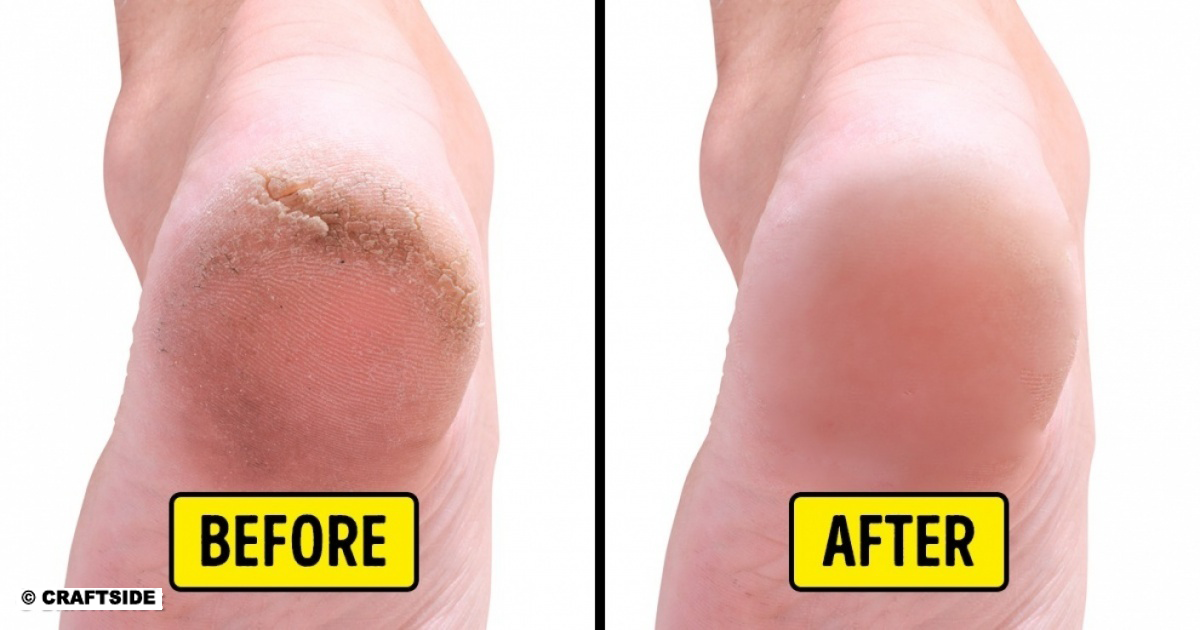 10 Home Remedies to Remove Cracked Heels and Get Beautiful Feet