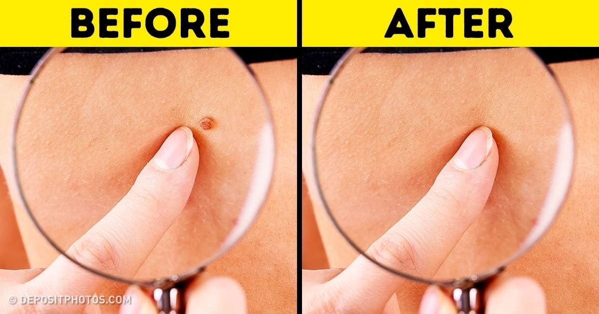 8 Effective Ways to Remove Skin Tags