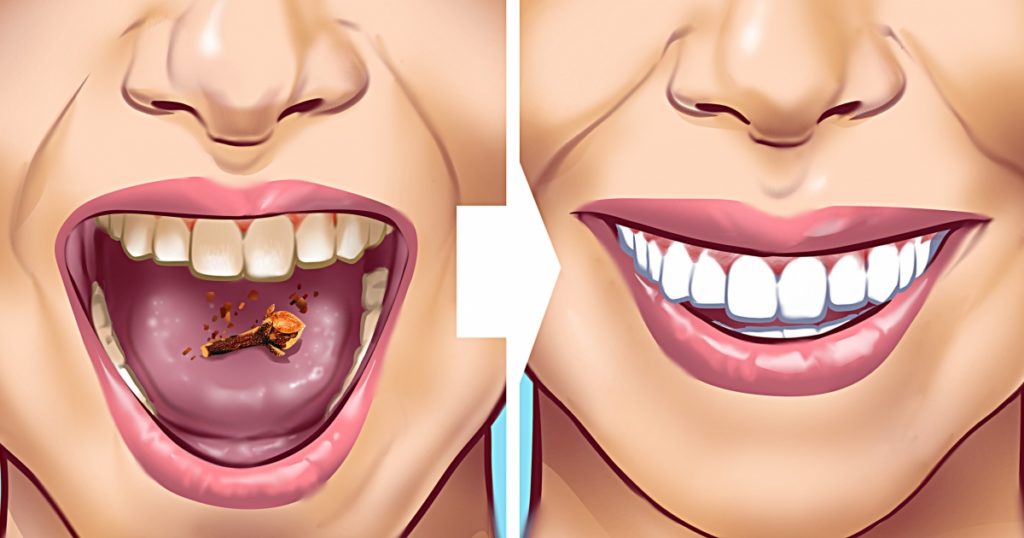 10 Home Remedies to Remove Tartar Stains From Your Teeth