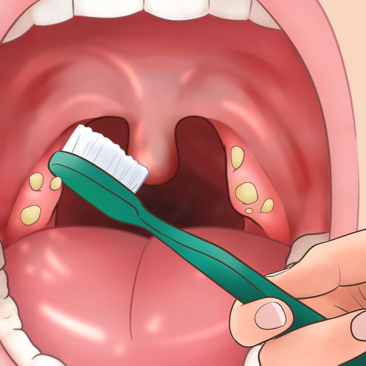 tonsil stones at home removal