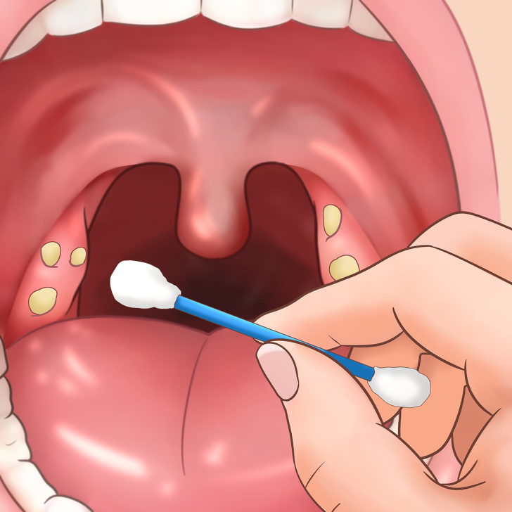 get rid of tonsil stones at home