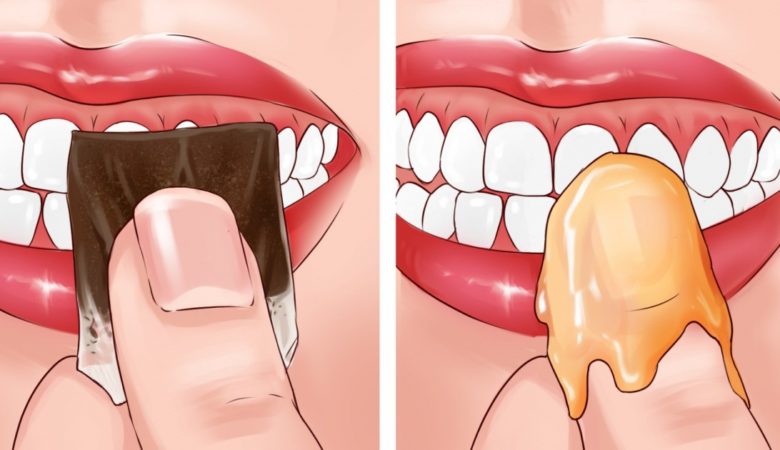 How To Treat Bleeding Gums Naturally at Home:10 Expert Tips