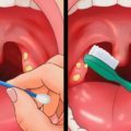 11 Tips How To Get Rid of Tonsil Stones At Home Fast