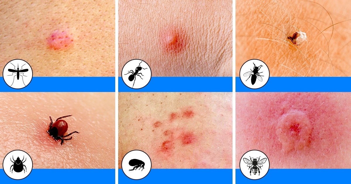bug bites that itch and swell
