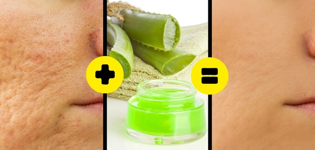 what gets rid of acne scars home remedies
