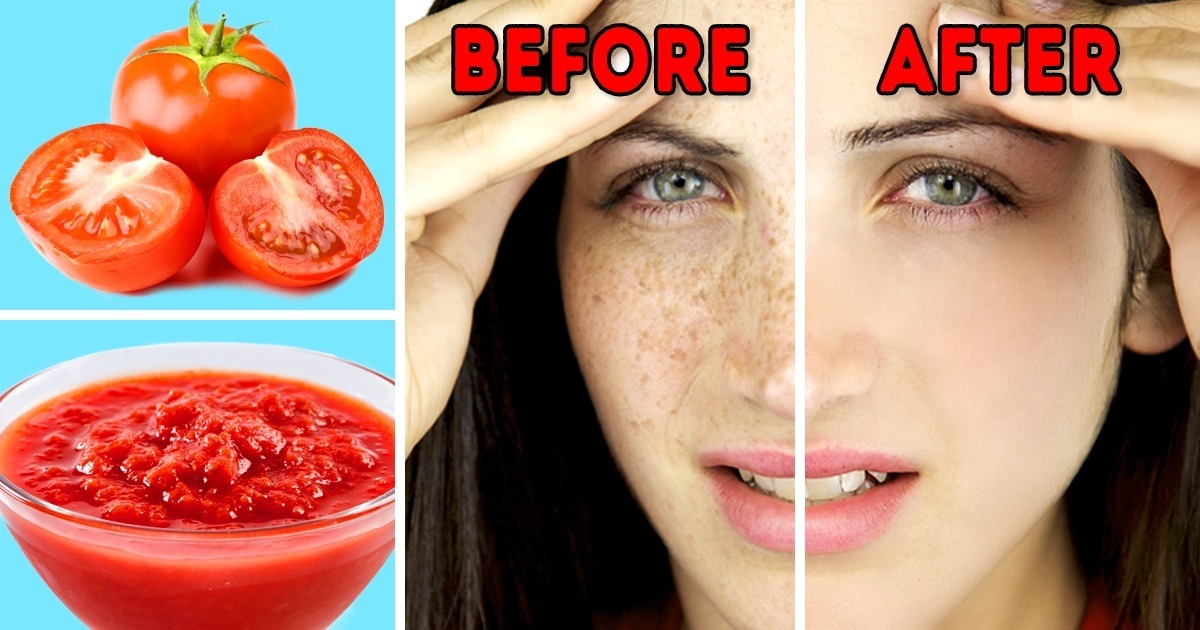 how-to-get-rid-of-sun-damage-on-face-home-remedies-youtube