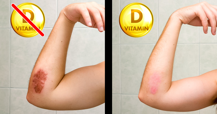 8 Signs That Your Body Desperately Needs More Vitamin D