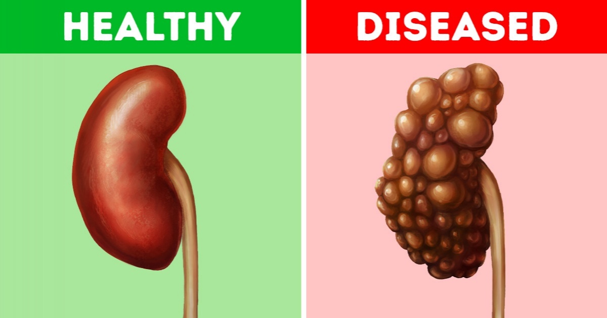 8-common-habits-that-can-damage-your-kidneys