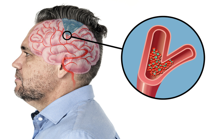 6 Warning Signs That Show a Stroke Is Coming, And You Don't Know 