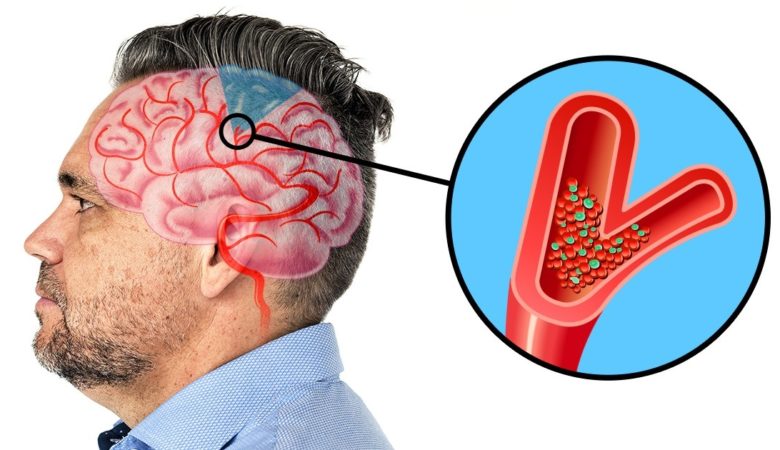 6 Warning Signs That Show a Stroke Is Coming, And You Don't Know