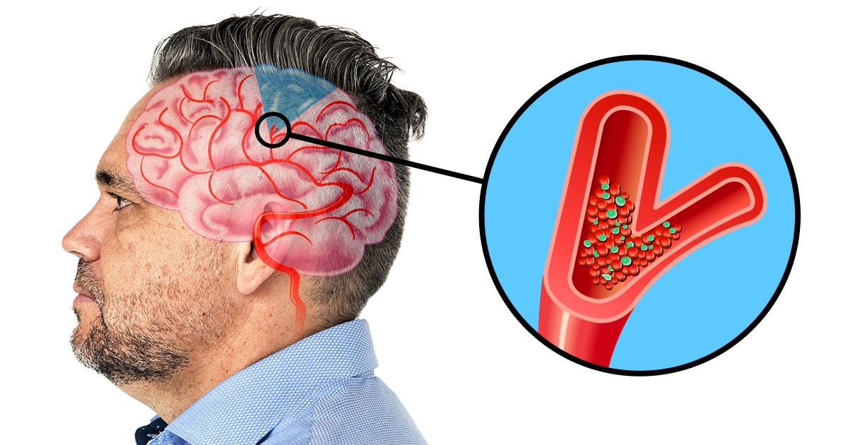 What Does It Mean To Have A Stroke In The Eye