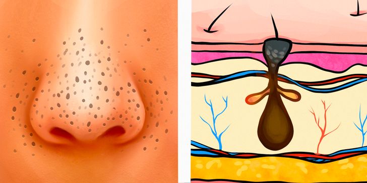 6 Different Types of Acne (Pimples) and What Might Cause Them