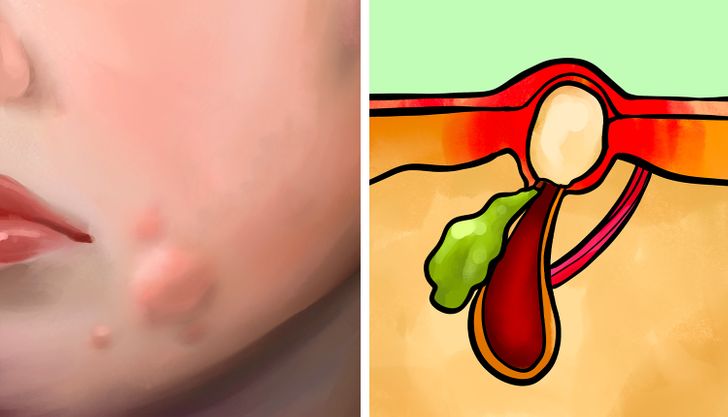 6 Different Types of Acne (Pimples) and What Might Cause Them