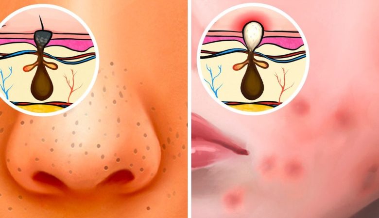 6 Different Types of Acne (Pimples) and What Might Cause Them
