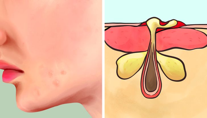 6 Different Types of Acne (Pimples) and What Might Cause Them