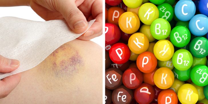 7 Health Problems That Can Be the Reason For Unexplainable Bruises on Your Body