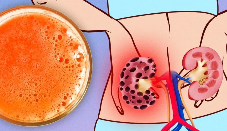 6 Popular Foods That Can Mess With Your Kidneys