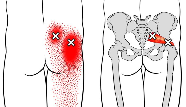 6 Key Tips To Treat Sciatic Nerve Pain Effectively