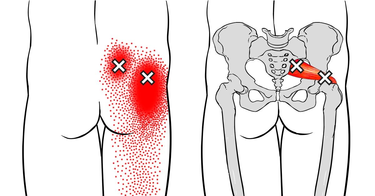 6 Key Tips To Treat Sciatic Nerve Pain Effectively