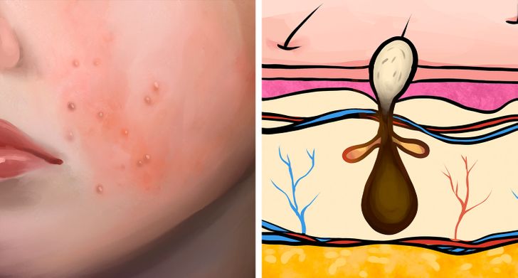 6 Different Types of Acne (Pimples) and What Might Cause Them