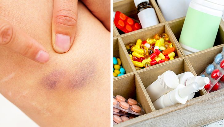 7 Health Problems That Can Be the Reason For Unexplainable Bruises on Your Body