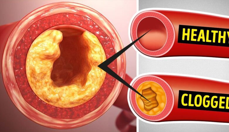 8 Foods to Avoid Like Fire If You Want to Unclog Your Arteries