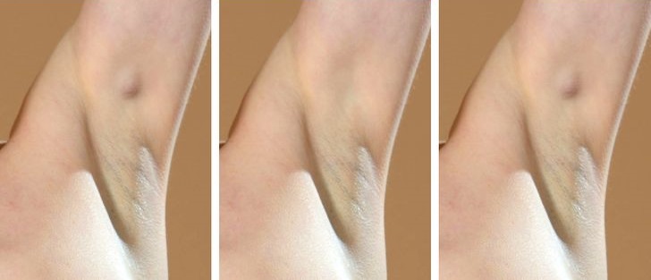 6 Lesser-Known Signs in the Armpits That May Indicate Health Problems