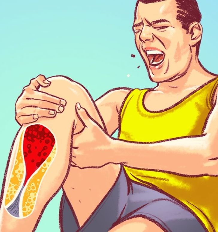 6 Dangerous Signs of Blocked Arteries We Often Ignore