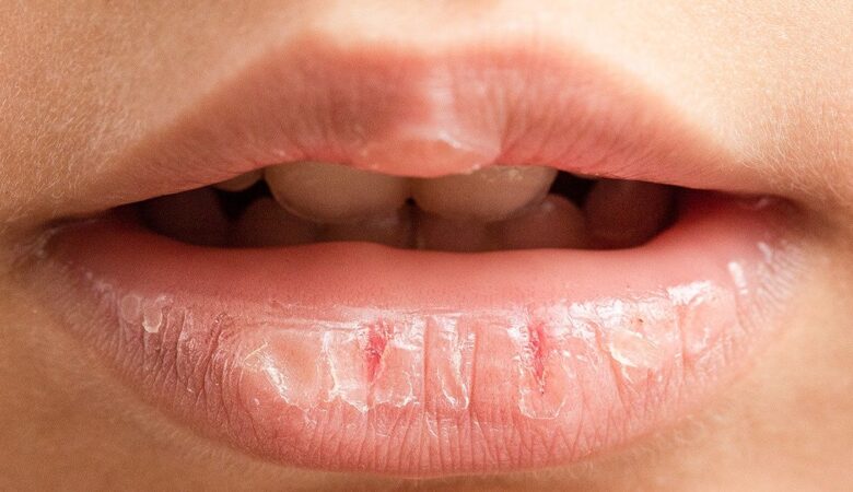 What Happens to Your Lips When You Use Lip Balm Too Often