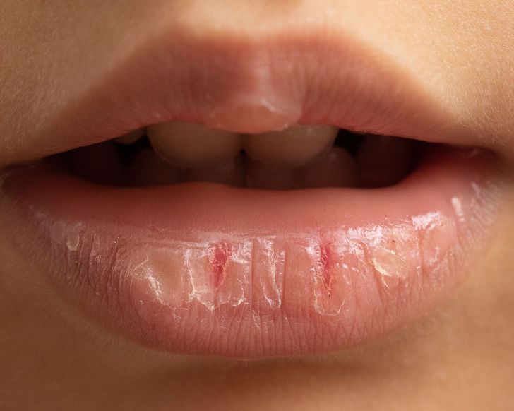 What Happens to Your Lips When You Use Lip Balm Too Often