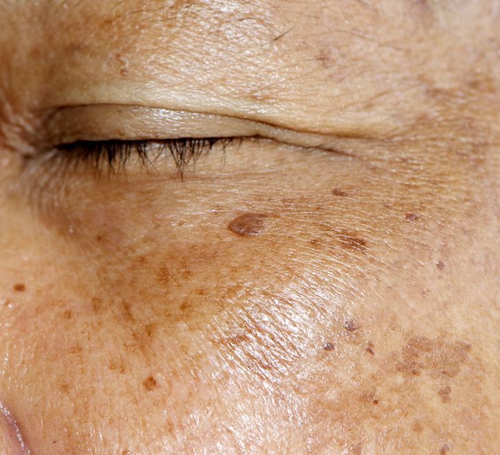 What Causes Skin Pigmentation and 3 Ways to Avoid It