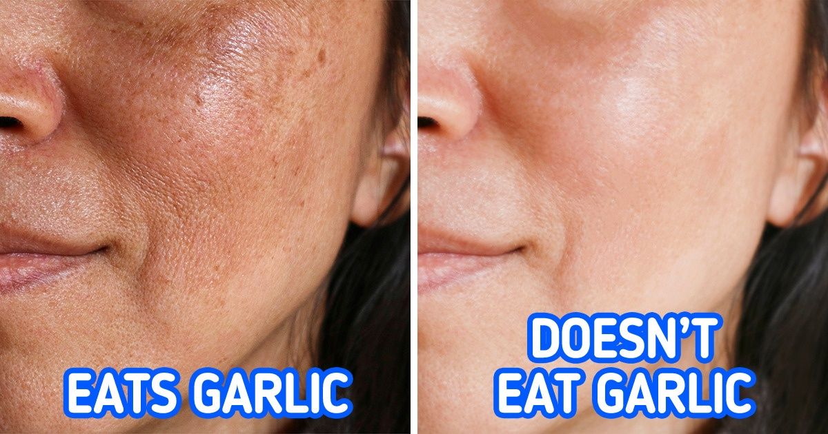 darker than normal pigmentation that appears as dark splotches is called: