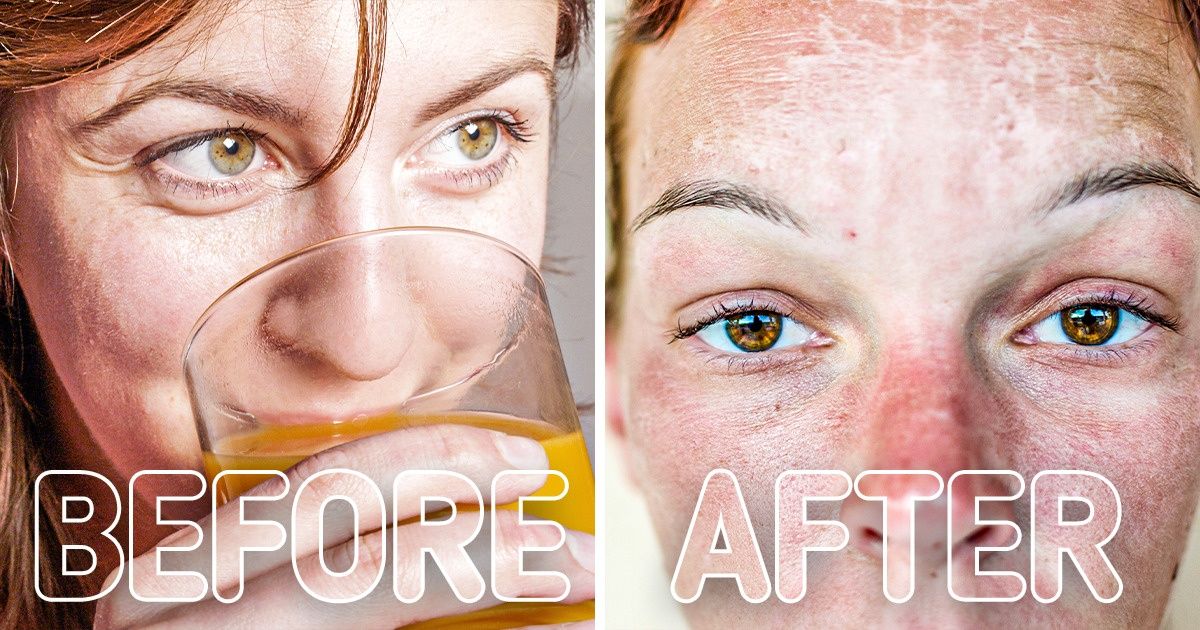 6 Things You Shouldn’t Do After Getting a Sunburn