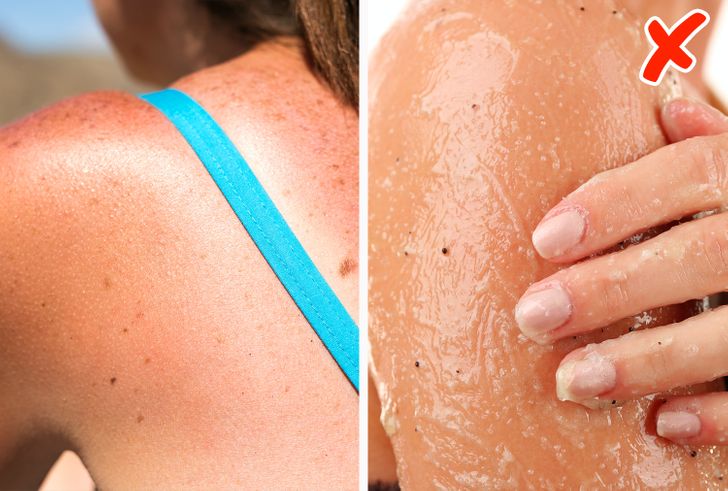 6 Things You Shouldn’t Do After Getting a Sunburn